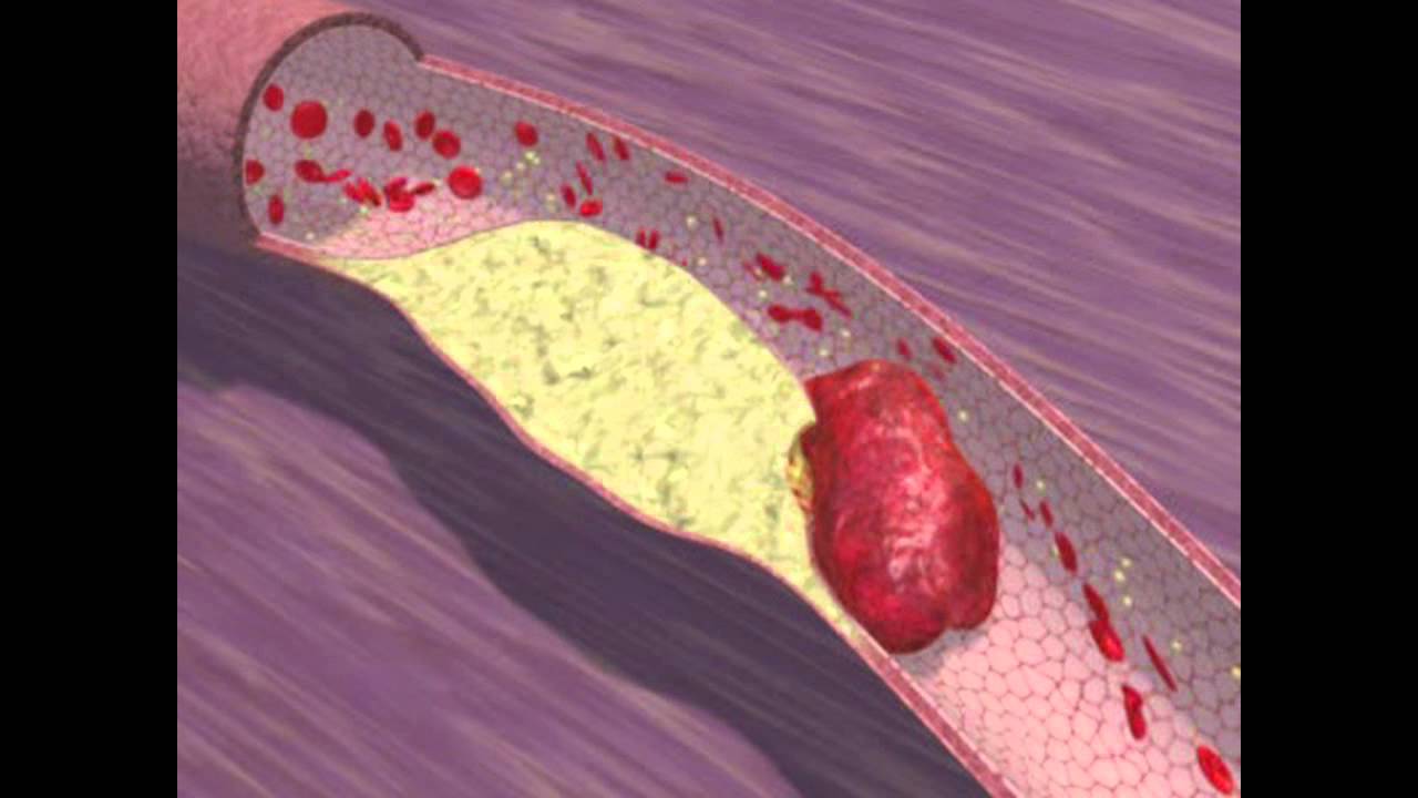 biologiepagina Hartinfarct(bloedprop)