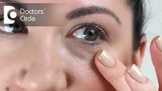 Causes of long lasting red splotcheses under the eyes? -  Dr. Rasya Dixit