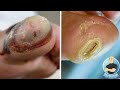 BIG TOE BLISTER IS BACK!!! ***HOW IS IT HEALING PT.2***