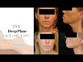 JIYA | Deep Plane Face & Neck Lift