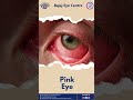 Did You Know? Your Eyes Can Be Affected By The Common Cold!