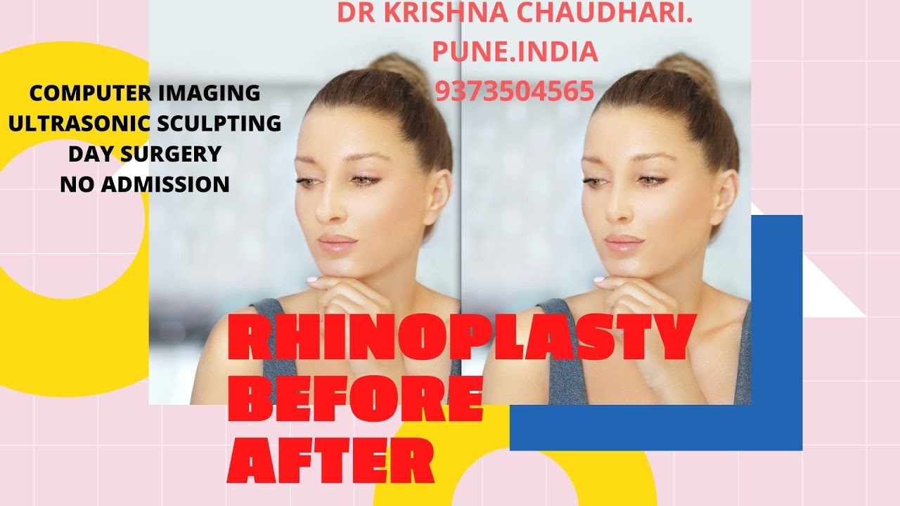 Rhinoplasty Before After Youtube