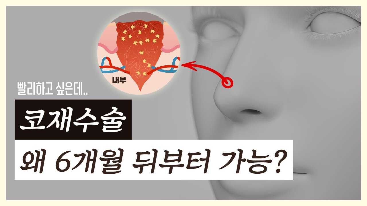 코재수술은 왜 꼭 6개월 뒤부터 가능한걸까 — 유튜브 영상 썸네일