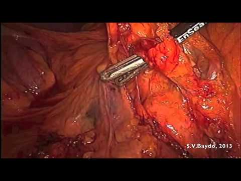 Laparoscopic Right Hemicolectomy