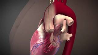 Direct Aortic TAVI Delivery Route