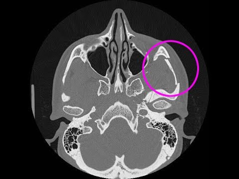 Der Knochenbruch: Computertomographie (CT) nach Reitunfall - Jochbeinbruch - YouTube