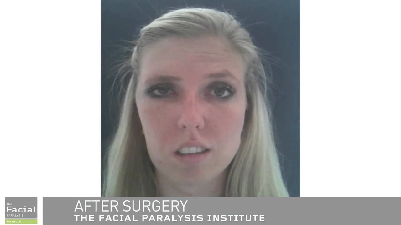 to repair paralysis Cosmetic surgery facial