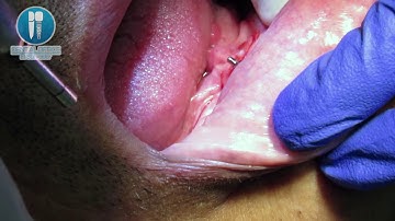 Colocación de sistema Easy2Fix