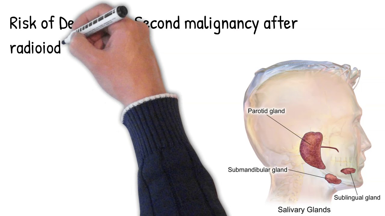 Radioiodine treatment can cause another new cancers. radioactive iodine