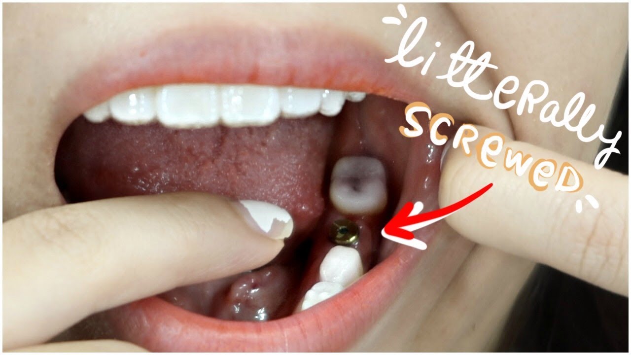 What actually happened after my BRACES came off. YouTube