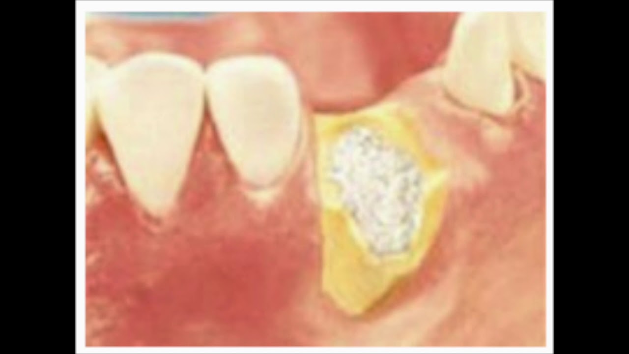 Rigenerazione ossea - Denti sani a Moncalieri - www.massimocappella.it