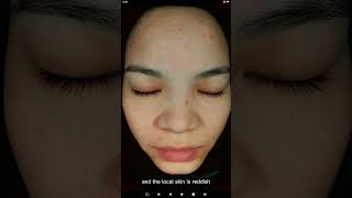 6、Interface explanation of skin evaluation instrument