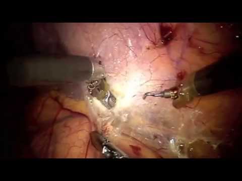 video phone lyrics daVinci Left Adrenalectomy