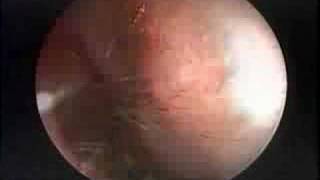 Endoscopic Treatment of a Large Left Frontal Sinus Mucocoele