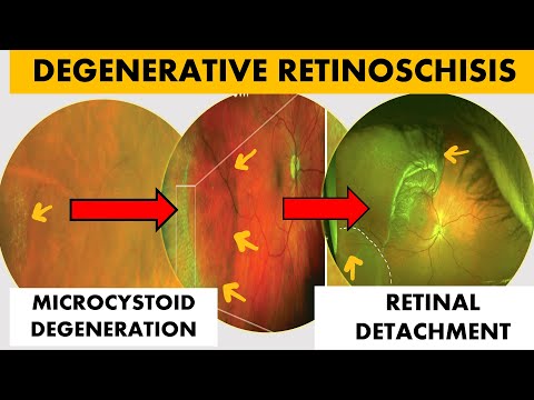 How To Differentiate Retinoschisis From Retinal Detachment