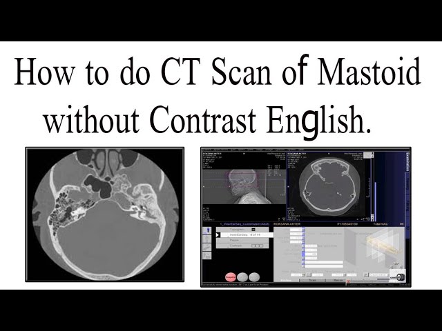 Scan of mastoid region English - YouTube