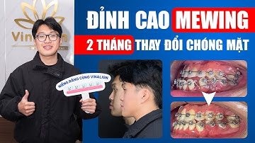 Mewing Đỉnh Cao - 2 Tháng Thay Đổi Chóng Mặt Nhờ Mewing | Nam Bùi Vinalign