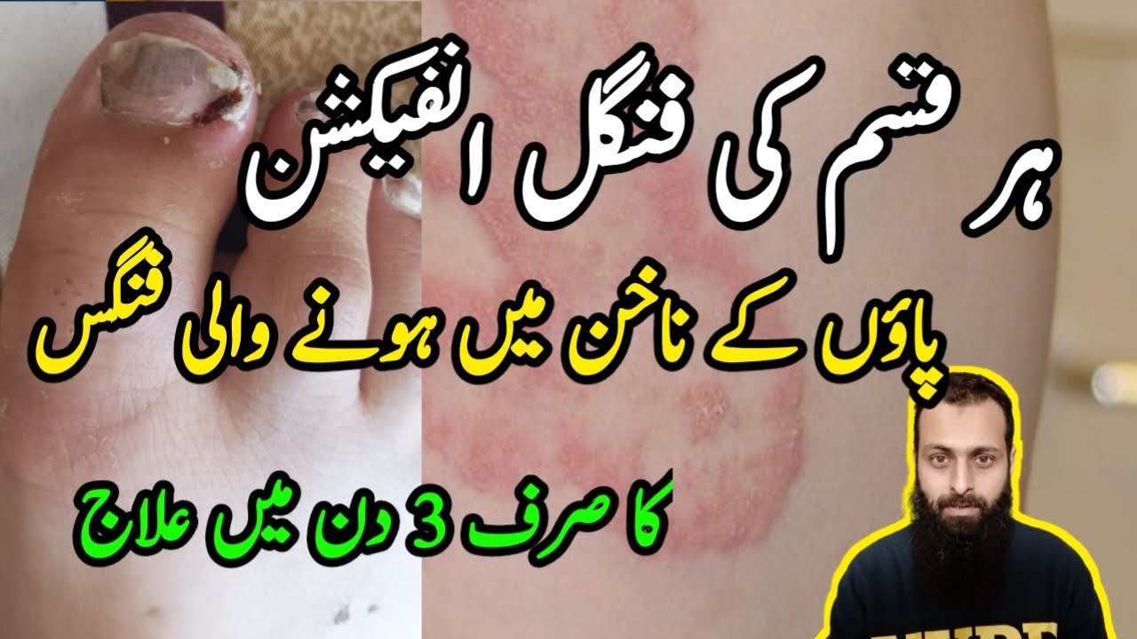 Fungal Infection Treatment Jism pe Fungus ka ilaj Ringworm on Skin