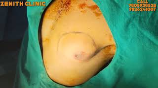 Puffy Nipple Surgery In Mumbai Delhi Hyderabad Bangalore Kolkata Chandigarh Lucknow Surat Nagpur