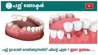 പല്ല്‌ ഉറപ്പായി വെയ്ക്കുന്നതിന്  ചെലവ്‌ എത്ര ? l Dental Bridge Costs: What You Need to Know