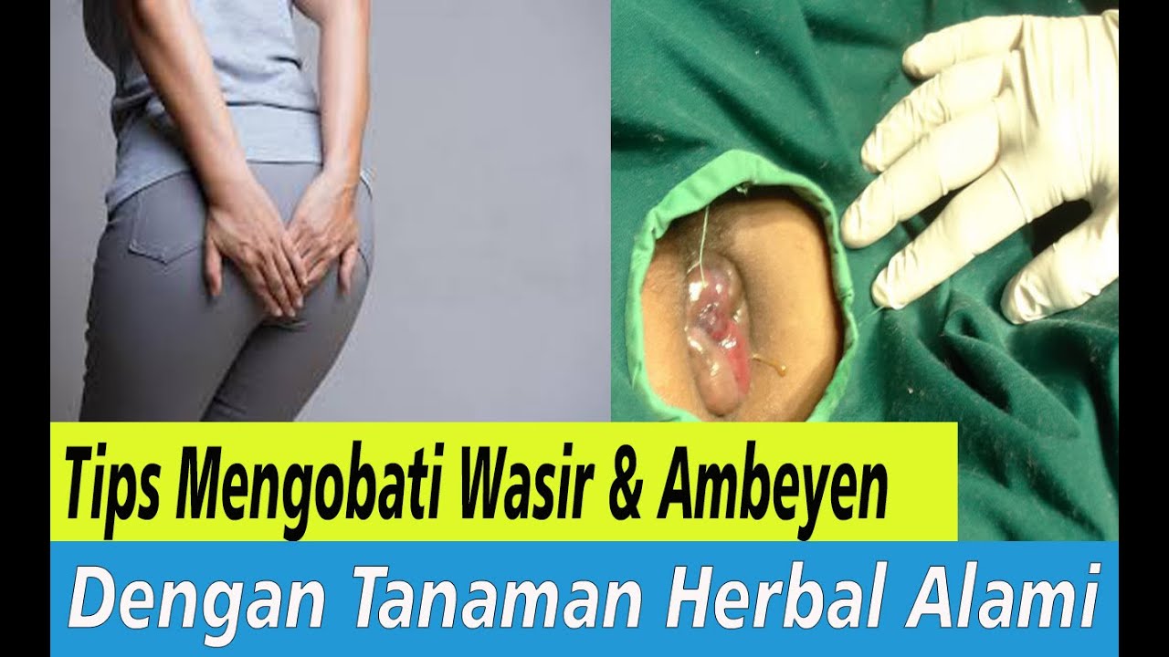 Cara mengobati wasir ibu hamil. Ampuh Dan Murah