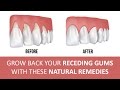 5 Effective Home Remedies for Gum Disease