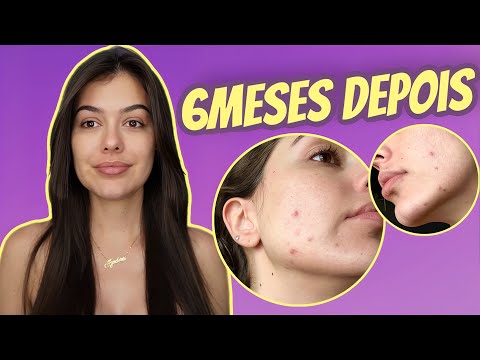 💊ANTES E DEPOIS DO ROACUTAN/ISOTRETINOINA - EXAMES APÓS O USO - ACNE HORMONAL