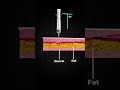 injection types