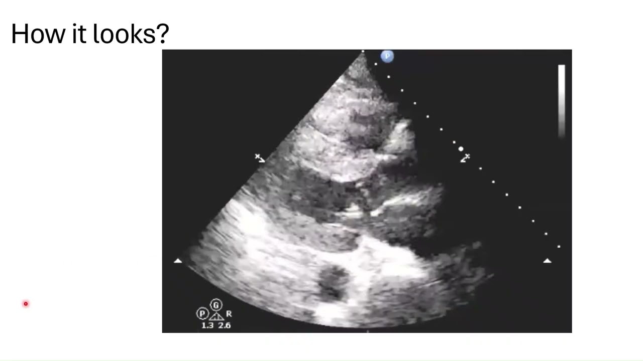 Dynamic LVOT Obstruction on Echo