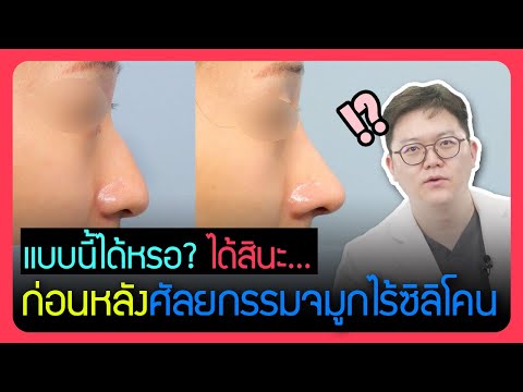 รีวิวศัลยกรรมจมูกแบบไร้ซิลิโคน ทำได้หรอ?
