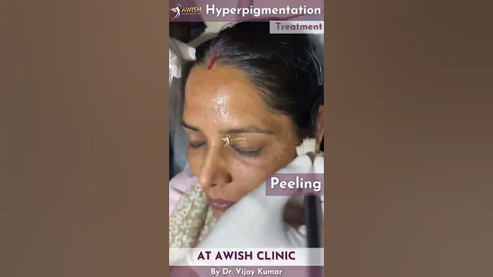 Hyperpigmentation treatment by peeling #hyperpigmetation #treatment #peeling #shorts #pigmentation