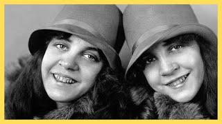 Top 10 Fascinating Siamese Twins in History