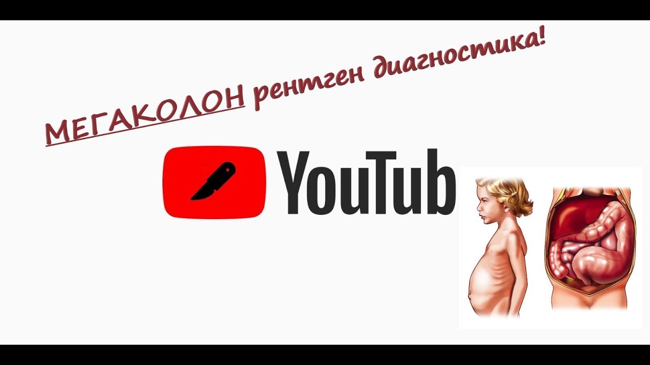 #медицина онлайн #Мегаколон #ирригография #Увеличение размеров толстого ...
