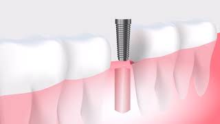 Tooth replacement therapy animated for science student template