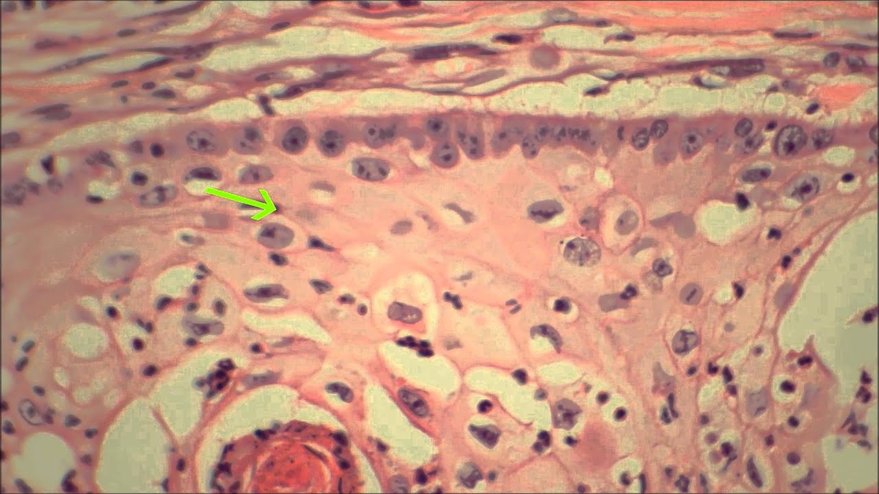 Carcinoma espinocelular