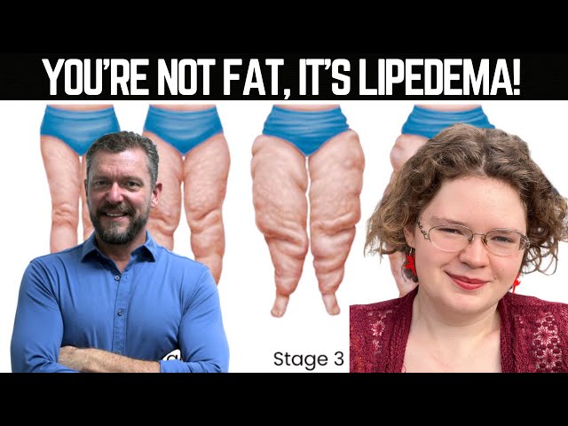 It's NOT Obesity, it's Lipedema [with Siobhan Huggins] class=