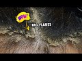 Big Dandruff Flakes Removal Satisfying On Front Side #407