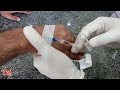 IV Cannula Insertion Demonstration | Medical Education🔬🧪🏥