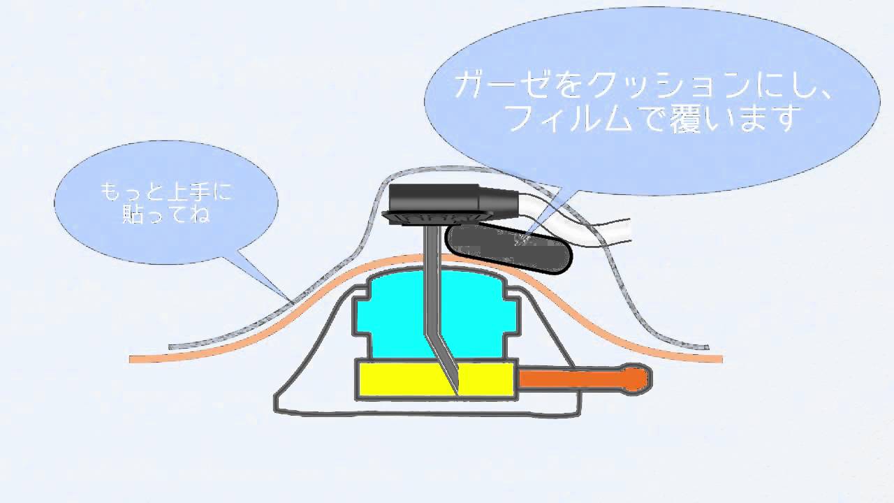 Cv ポート 看護