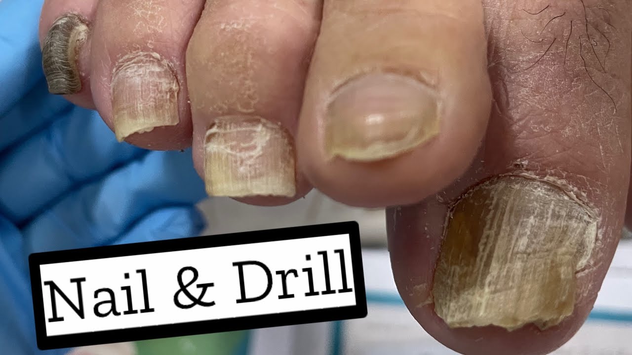 nail /toenail /nailcare /athlete’s foot /practice /nail&drill YouTube