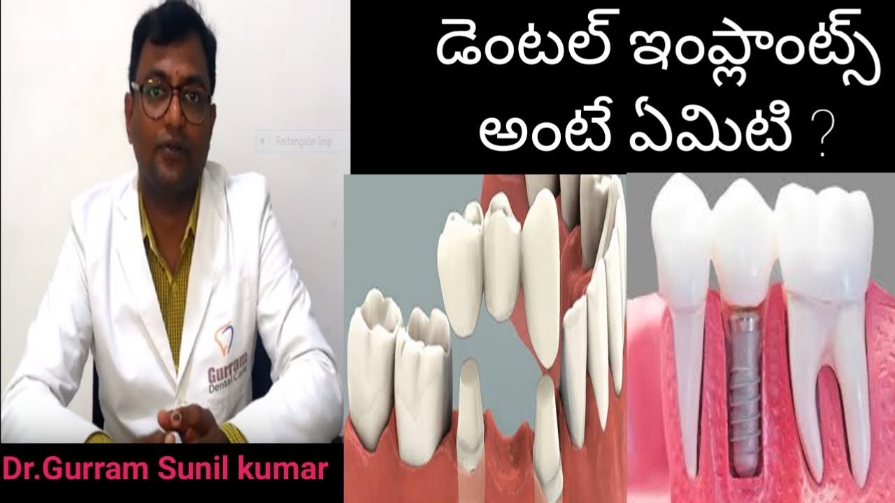 Dental Implants explained by Dr. Gurram sunil kumar in telugu Dental