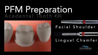 PFM Preparation  Acadental Tooth #30 | Dr. Richard Stevenson