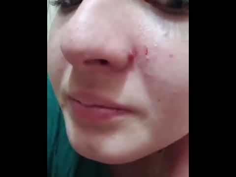 Чистка Кожи у Косметолога. Выдавливание Прыщей. Удаление Черных Точек и ...