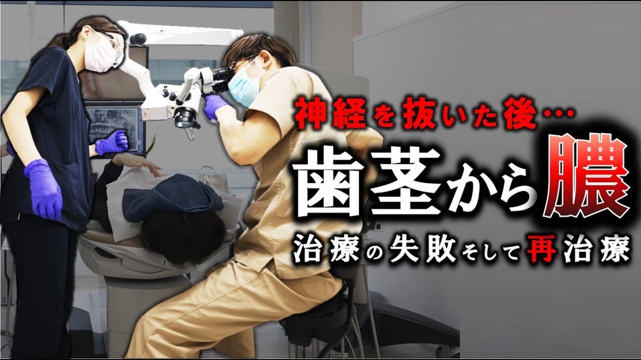 【失敗＆再治療】歯の矯正治療後の根管治療…なぜ歯茎が腫れてしまったのか…原因は⁉（おまけ動画：歯医者の日曜に密着）　※上顎の小臼歯 イスムス感染残存に対する再根管治療の動画　＃イスムス