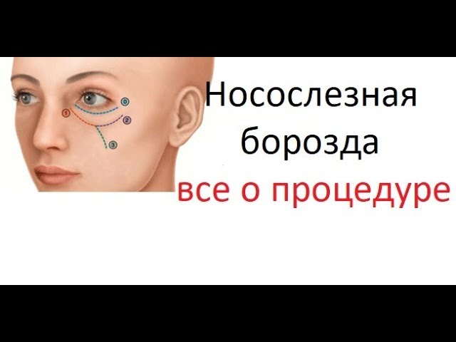 Как убрать мешки и синяки под глазами за один день. Коррекция носослезной борозды.