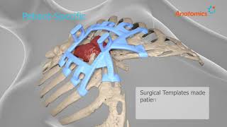 Incredible World First Ribcage Implant Becomes 'alive'