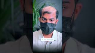 Hair loss started at just 23… and he couldn't stop checking his hair. 💔