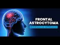 Frontal Astrocytoma | Intersulcul Approach | Dr. Sukhdeep Singh Jhawar(Neurologist in Ludhiana)