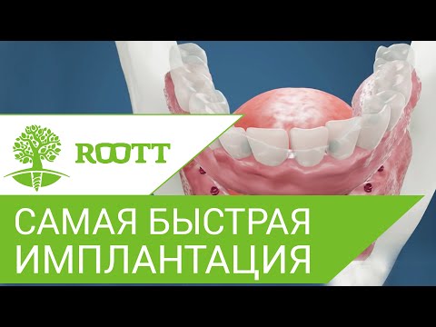 👍 Все на 8 имплантах: самый быстрый метод восстановления зубов. Все на 8 имплантах. ROOTT. 12+