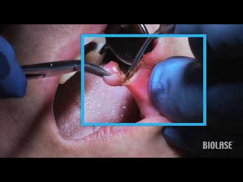 Vídeo: Fibroma De La Cavidad Oral: Causas Y Síntomas Del Fibroma De La Lengua Y El Fibroma De Las Encías